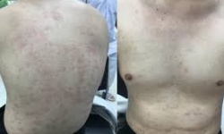 Quan hệ tình dục không an toàn khiến số ca giang mai tăng ở nhóm MSM