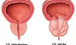 Phì đại tiền liệt tuyến: nguyên nhân, triệu chứng và cách xử lý